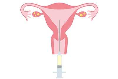 人工授精のイメージイラスト